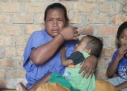 Derita Bocah 4,5 Tahun di OKU Timur, Alami Kelainan Tulang dan Terbentur Biaya Pengobatan